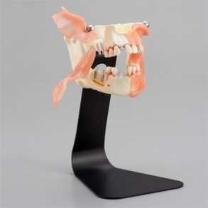 Implantat Studiemodel 